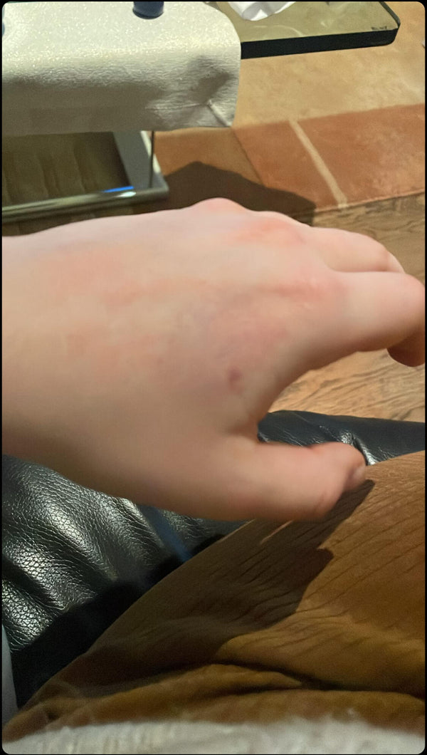 Hanna Hand nachher