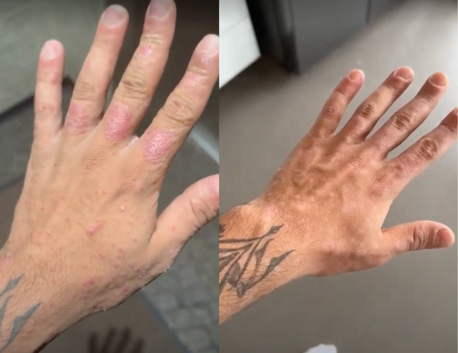 Elias Hand vorher und nachher