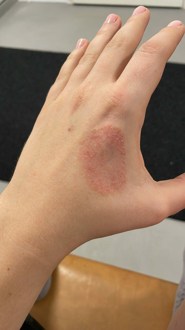 Hanna Hand vorher